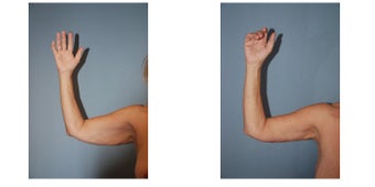 Arm Lift before 264602