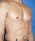 Pec Implants 887780
