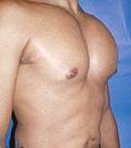 Pec Implants 887780