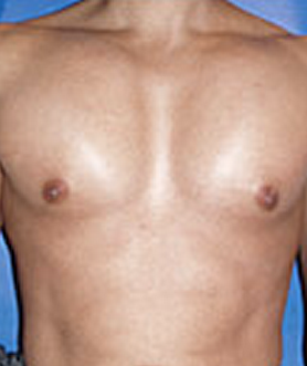 Pec Implants after 887780