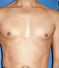 Pec Implants before 887780