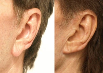 Earlobe Reduction after 665520