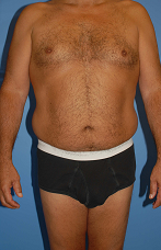Male Liposuction 289513