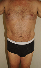 Male Liposuction 289513