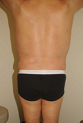 Male Liposuction after 289513