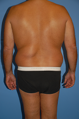 Male Liposuction before 289513