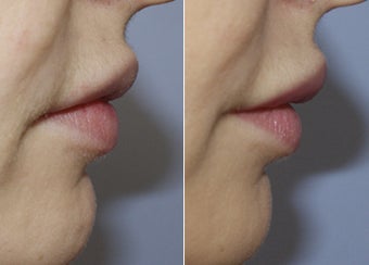 31 Year Old Female - Filler to Lips after 1229011