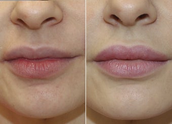 31 Year Old Female - Filler to Lips before 1229011