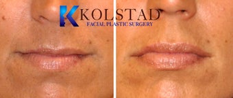Natural Lip Augmentation before 1260554