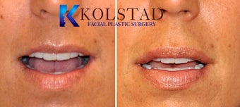Natural Lip Augmentation after 1260554