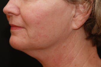 Skin Tightening for the Lower Face and Neck after 123690