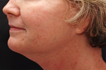 Skin Tightening for the Lower Face and Neck before 123690