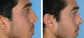 Functional Rhinoplasty before 1208306