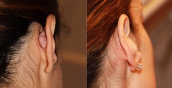 Excision of Keloid Scar Behind the Ear before 1367892
