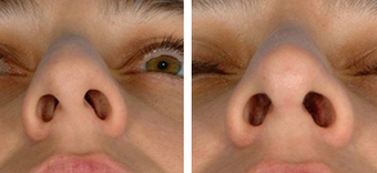 Functional Rhinoplasty before 1208318