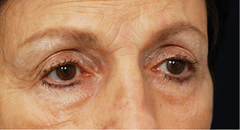 Eye Bag Surgery 886808