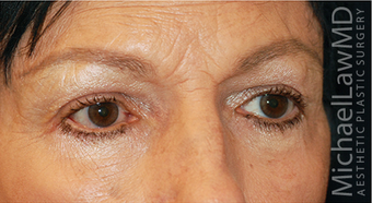 Eye Bag Surgery 886808