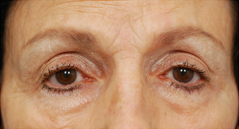 Eye Bag Surgery before 886808
