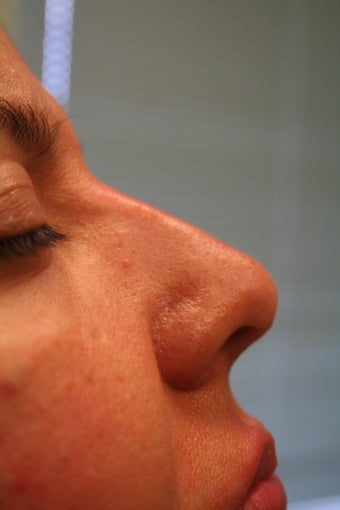 Non-surgical Rhinoplasty after 359600