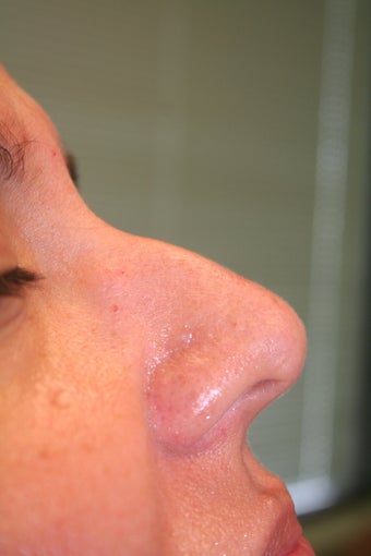 Non-surgical Rhinoplasty before 359600