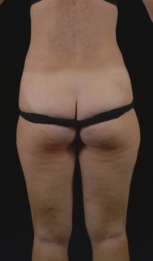 Liposuction 513562