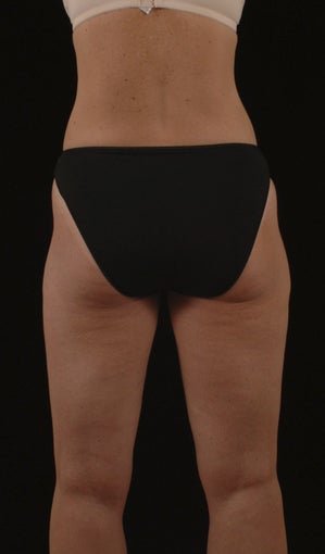 Liposuction 513562