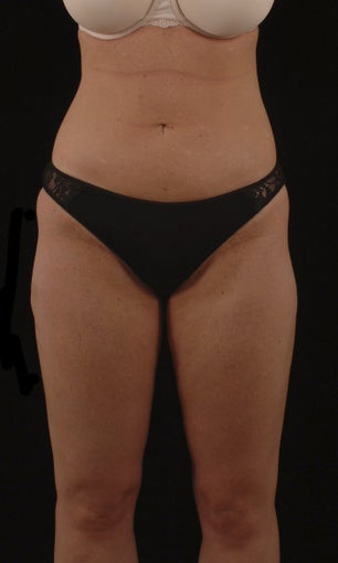 Liposuction after 513562