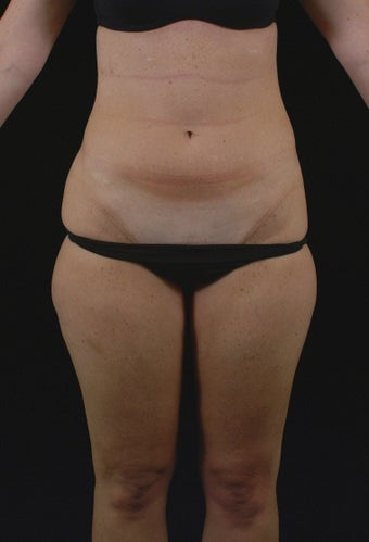 Liposuction before 513562