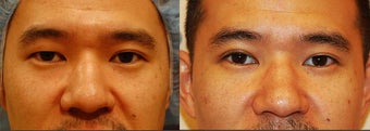 Male Asian Eyelid Surgery before 906396
