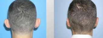 Otoplasty before 258813