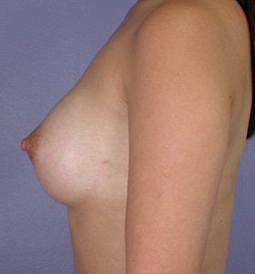 Breast Augmentation after 281444