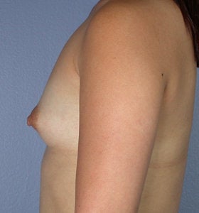 Breast Augmentation before 281444