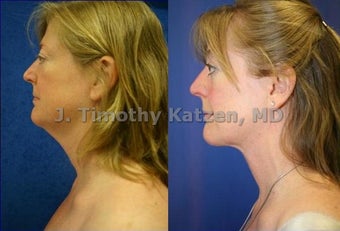 Neck liposuction before 667233