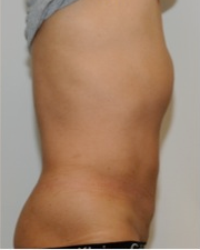 Male Liposuction Before and After - 3 Months 814324
