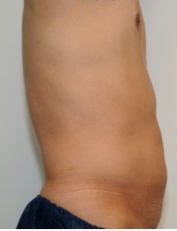 Male Liposuction Before and After - 3 Months 814324