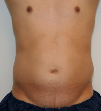 Male Liposuction Before and After - 3 Months before 814324