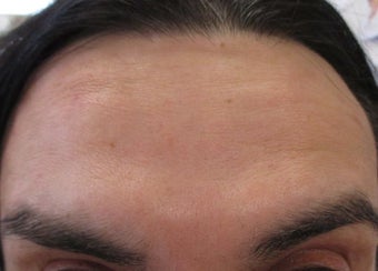 47 year old male treated for forehead wrinkles with Botox after 1245352