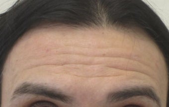 47 year old male treated for forehead wrinkles with Botox before 1245352