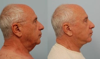 Neck Lift before 575007