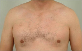 Smart Lipo of the chest after 455693