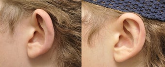 Otoplasty - 23 year old male with Protruding Ears before 1067679