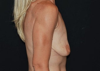 Breast Lift before 949232