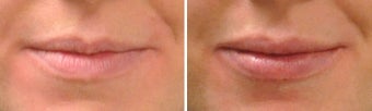 Lip Augmentation before 809789