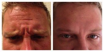 Young Male Treated for Forehead and Glabellar Wrinkles before 1367262