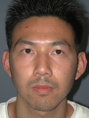 Otoplasty/Ear Surgery before 731984