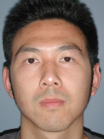 Otoplasty/Ear Surgery after 731984