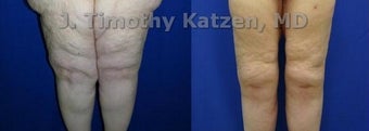 Thigh Lift after massive weight loss before 667187