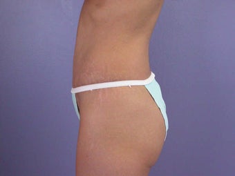 Tummy Tuck after 280080