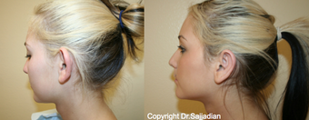 Ear Surgery before 1245310