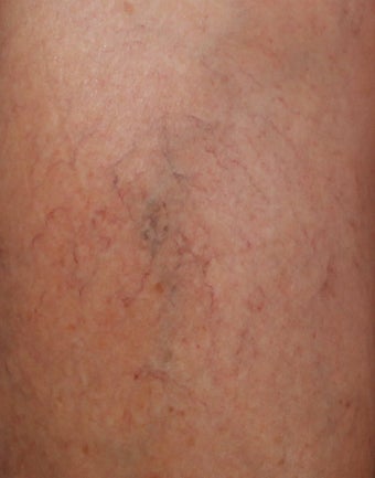 Sclerotherapy for Leg Veins after 1357681